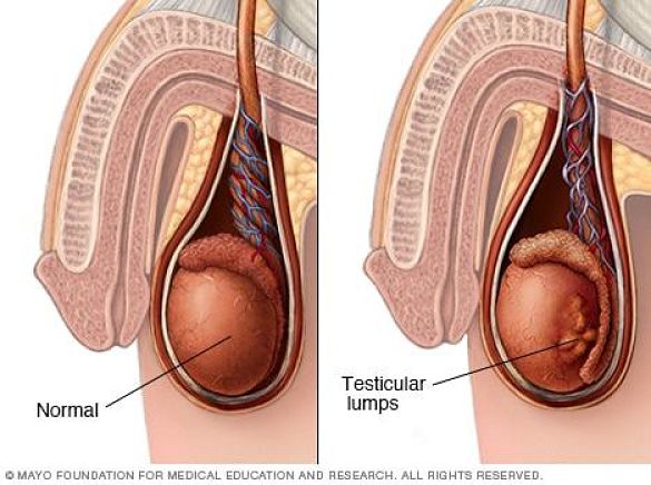 Cáncer de Testículo Tratamiento en Xela | urosurgt.com