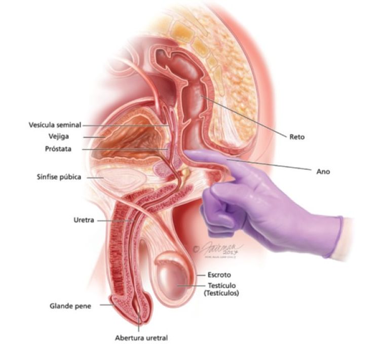 Cáncer de Próstata Tratamiento en Xela | urosurgt.com