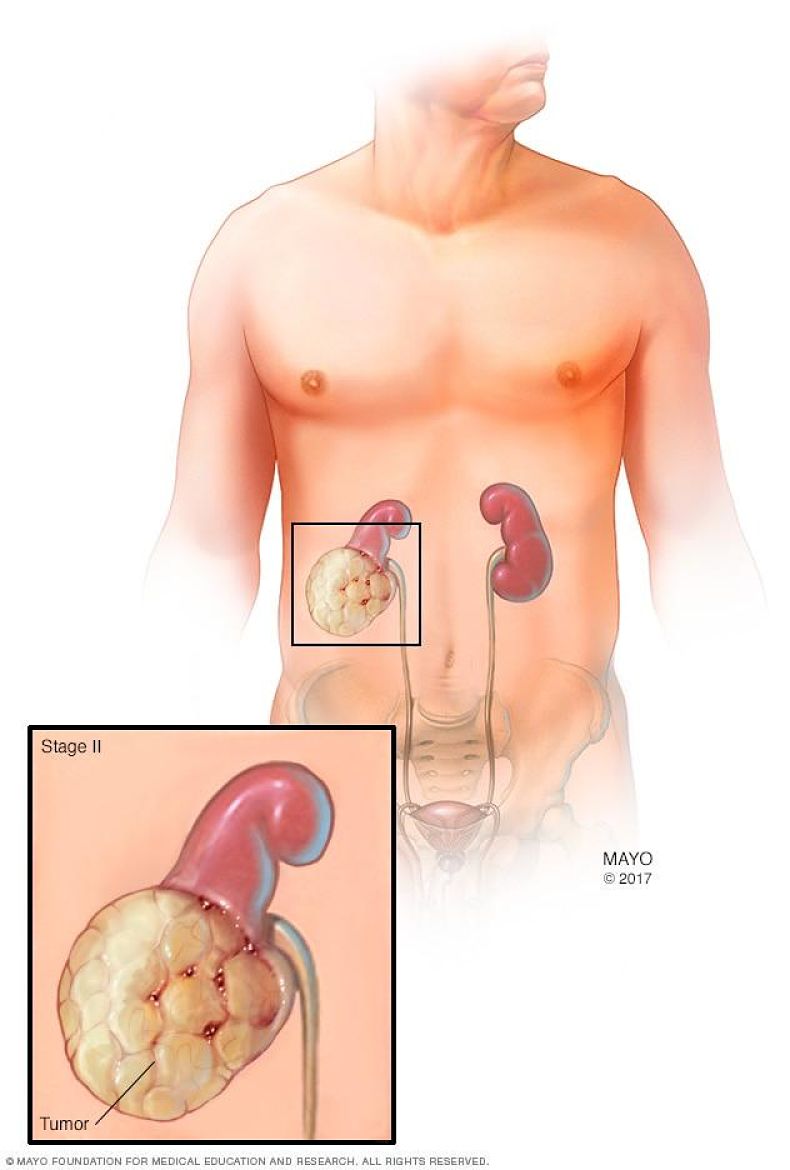 Cáncer de Riñón - Diagnóstico y tratamiento urológico avanzado