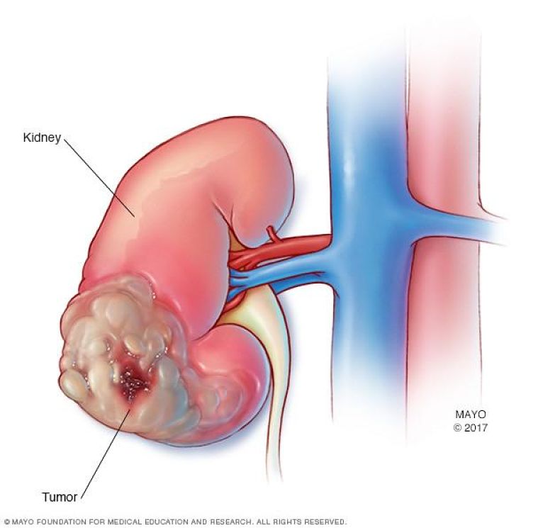 Cáncer de Riñón Tratamiento en Xela | urosurgt.com