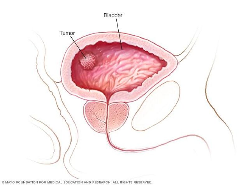 Cáncer de Vejiga Tratamiento en Xela | urosurgt.com