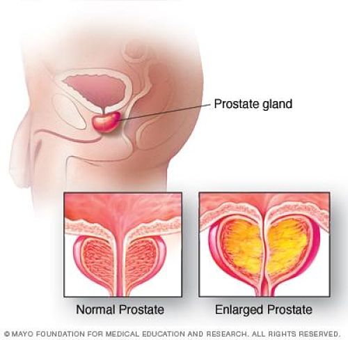 Hiperplasia Benigna de Próstata - Agrandamiento prostático y tratamiento urológico