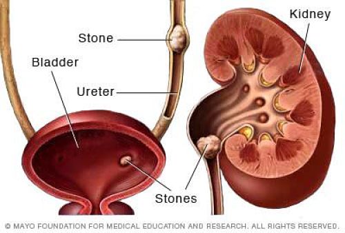 Tratamiento de Litiasis (cálculos) de Vías Urinarias | urosurgt.com
