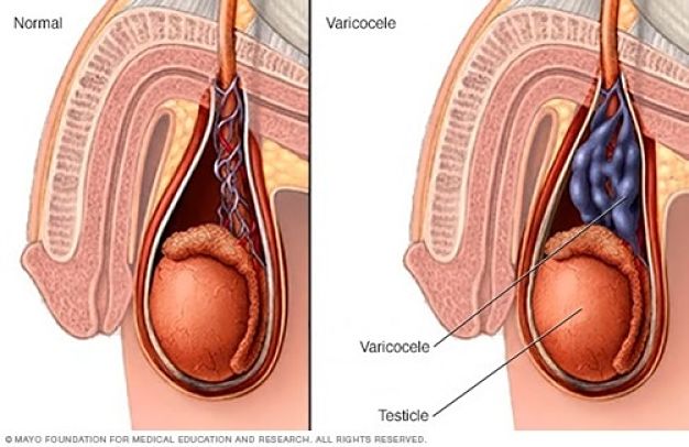 Especialista en Varicocele | Urología | urosurgt.com